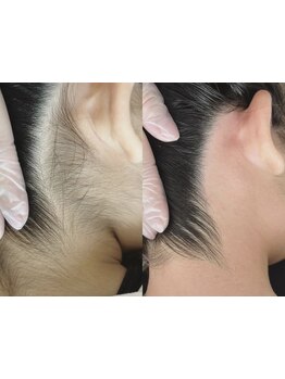 パーツ脱毛のできるサロン