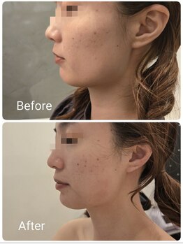 サロン ド ハニー(Salon de Honey)/レモンボトル