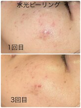 ルミネル 名古屋新栄(Luminelle)/水光ピーリング