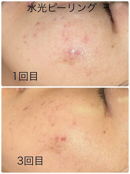 ルミネル 名古屋新栄(Luminelle)/水光ピーリング