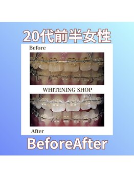 ホワイトニングショップ 西原店/20代前半女性☆BeforeAfter
