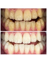 セルフメイド 石巻店/ホワイトニングビフォーアフター