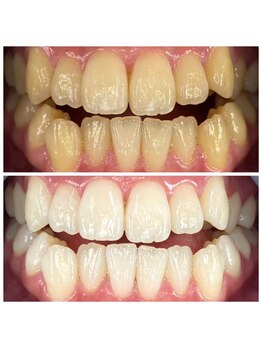 セルフメイド 石巻店/ホワイトニングビフォーアフター