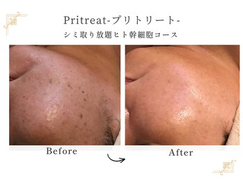 プリトリート(Pritreat)/シミケアし放題&ヒト幹細胞
