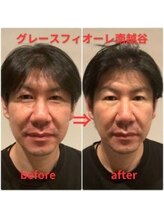 グレースフィオーレ 南越谷店(gracefiore)/男性美容｜小顔｜リフトアップ