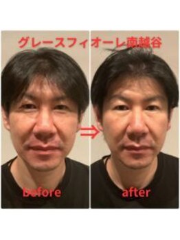 グレースフィオーレ 南越谷店(gracefiore)/男性美容｜小顔｜リフトアップ