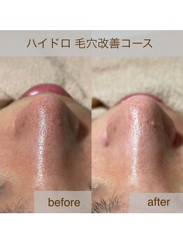 トータルビューティーサロン ティティ(Titi)/毛穴の黒ずみ&角栓もゴッソリ!