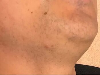 ポポのエステ(popoのエステ)の写真/1500円から始めるメンズ脱毛！忙しい朝の準備時間を短縮して清潔感のある素肌を手に入られる♪