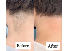 リリー(Lily)/【うなじワックス脱毛】