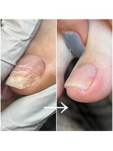 リネイル 長浜(Re-na-iL)/ネイルケア＆スパ¥7000