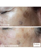 ロータス 千早香椎店(Lotus.)/シミケア４回目