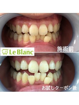 ルブラン 奈良店(Le Blanc)/【お試しの効果】