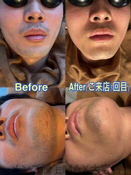 メンズ脱毛マックス 大宮店(MAX)/ヒゲ脱毛のビフォーアフター写真