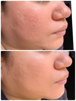 ビーエスアクアビューティー/ララピーリング１回