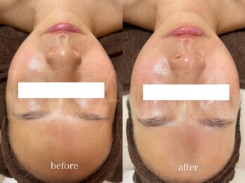 ルアナ(LUANA)/フェイシャルWAX脱毛