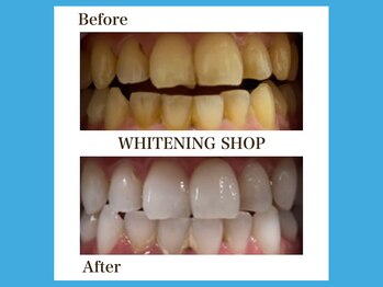 ホワイトニングショップ 福岡春日店/丁寧なカウンセリングで美白へ