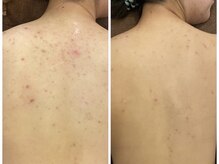 ミベル フェイシャルサロン(MIBELL FACIAL SALON)/お客様症例★背中