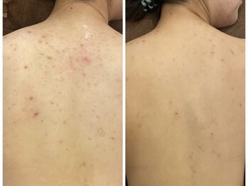 ミベル フェイシャルサロン(MIBELL FACIAL SALON)/お客様症例★背中