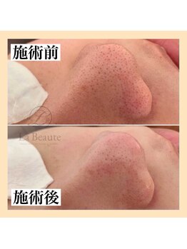 ピュール 鯖江店(PUR)/毛穴サロン/毛穴ケア/毛穴洗浄