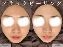 レヴェリー 心斎橋店(REVERIE)/- ブラックピーリング -