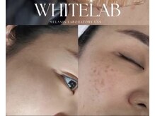 アンジー(ANGIE)の雰囲気（光フェイシャルやプラズマでもない！塗る最新シミケア！）