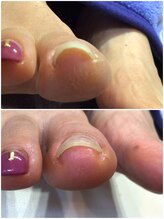 モアクリスタル(More Crystal)/巻き爪補正