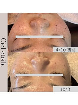 シエルエトワレ/肌質改善コース