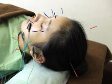 いなほ はりきゅう整骨院 東新宿/美容鍼施術/電子パルス