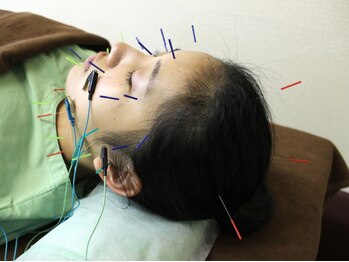 いなほ はりきゅう整骨院 東新宿/美容鍼施術/電子パルス
