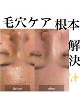 サロンツキ(salon tuki)/【ハーブピーリング】症例★