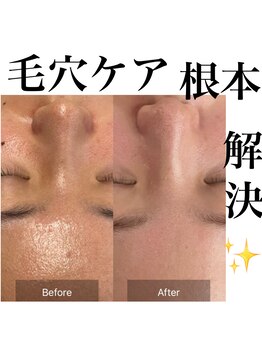 サロンツキ(salon tuki)/【ハーブピーリング】症例★