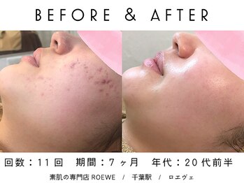 ロエヴェ(ROEWE)/ニキビ改善・毛穴ケア・肌質改善
