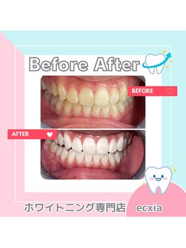 エクシアホワイトニング 札幌中島公園店/Before After［ホワイトニング］