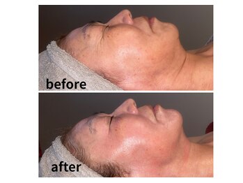 ブレアドール(Blair-Doll)/たるみ・目元たるみ改善★