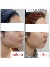 ミュー(Mieux)/長年の跡が美肌へ