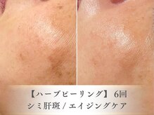 ベルペール(Belle perle)/【ハーブピーリング】毛穴/シミ