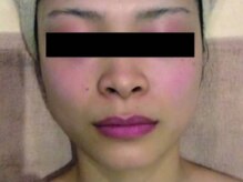 シュシュ 恵比寿店(Chou chou)/小顔/リフトアップ/ほうれい線