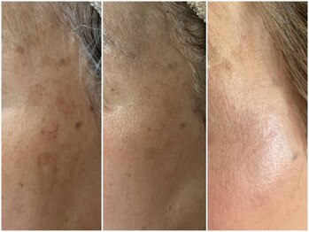 リュミエール デスポワール(Lumiere d'espoir)/ハーブピーリング