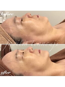 ファビリス 天王寺店(FAVILIS)/エイジングケア/50代