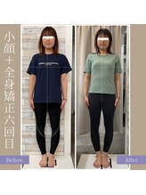 キアラ(chiara)/小顔＋全身矯正6回目(正面)