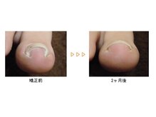 改善 根本 恵比寿院/施術例[巻き爪/東京/恵比寿]