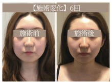 ドクターボディ 恵比寿店(Dr.Body)/【顔大きさ/小鼻縮小 20代】