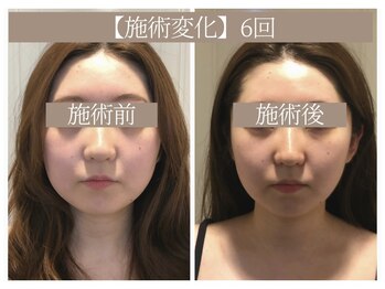 ドクターボディ 恵比寿店(Dr.Body)/【顔大きさ/小鼻縮小 20代】