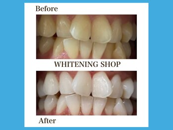 ホワイトニングショップ 福岡春日店/圧倒的な白さ・輝きを実現