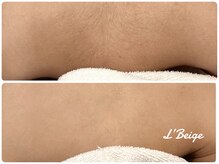 レ ベージュ(L’Beige)/３才からのキッズ脱毛