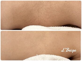 レ ベージュ(L’Beige)/3才からのキッズ脱毛