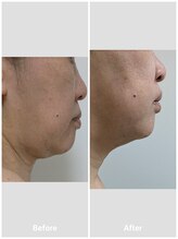 カナウ(Kanau)/レモンボトル5回目施術直後