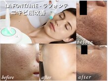 リリィ/ニキビ肌にラフォンテピーリング