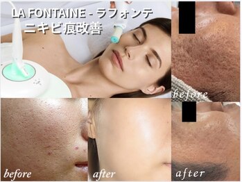 リリィ/ニキビ肌にラフォンテピーリング
