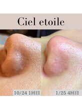 シエルエトワレ/毛穴エクストラクション